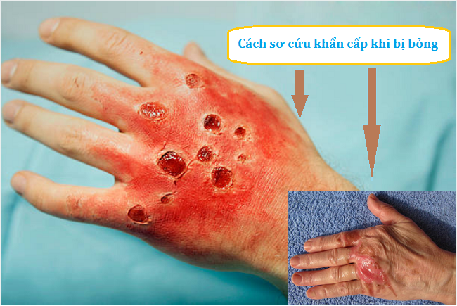 cách sơ cứu khi bị bỏng