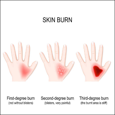 cách sơ cứu khi bị bỏng