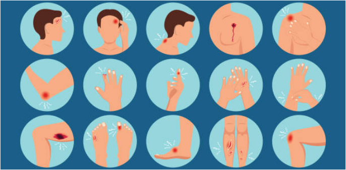 cách sơ cứu khi bị bỏng