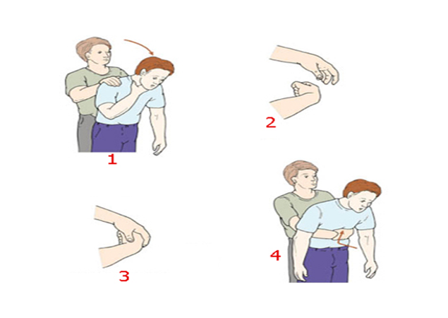 hướng dẫn sơ cứu người bị hóc dị vật đường thở - chi tiết cho từng đối tượng