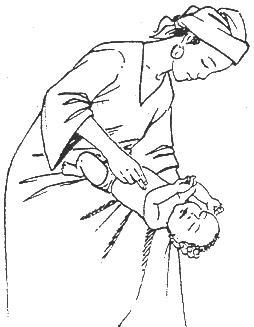 hướng dẫn sơ cứu người bị hóc dị vật đường thở - chi tiết cho từng đối tượng
