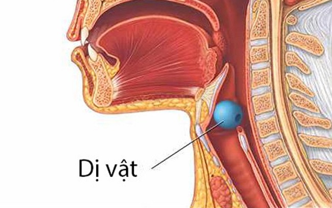 trẻ bị hóc dị vật đường thở, xử lý thế nào